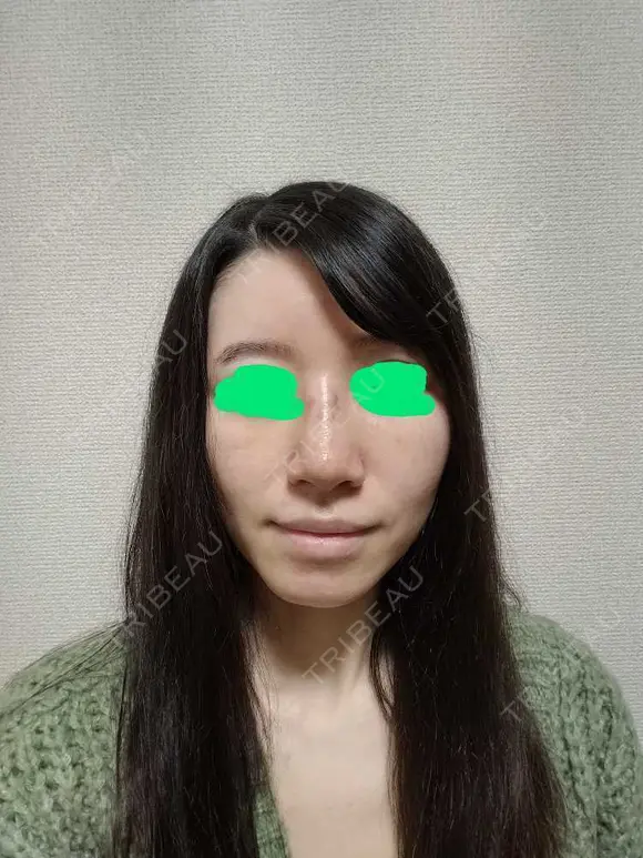 隆鼻術 / 鼻尖形成（切開） / 鼻中隔延長（切開） / 小鼻縮小（切開） / 軟骨移植 / ワシ鼻修正・ハンプ切除 4Dクリニック AFTER メイン用