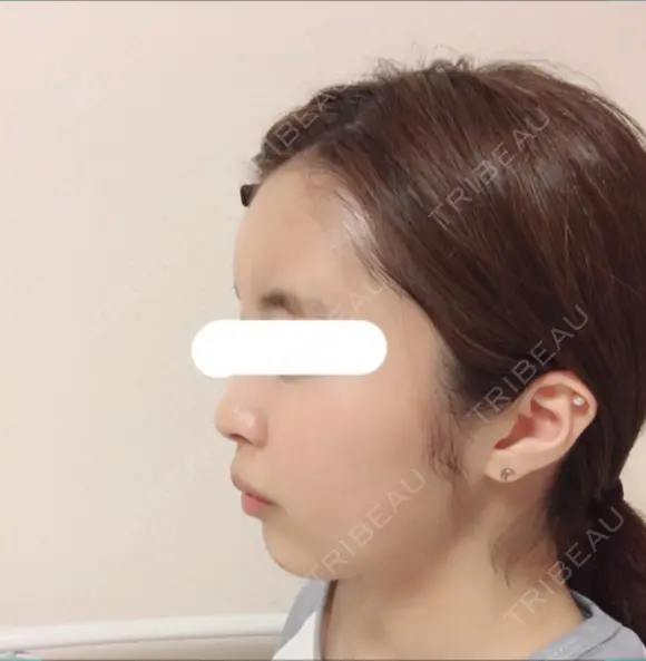 脂肪注入（輪郭） / 再生医療 / PRP皮膚再生療法 チョンダムオラクル皮膚科整形外科医院 DAY 12 メイン用