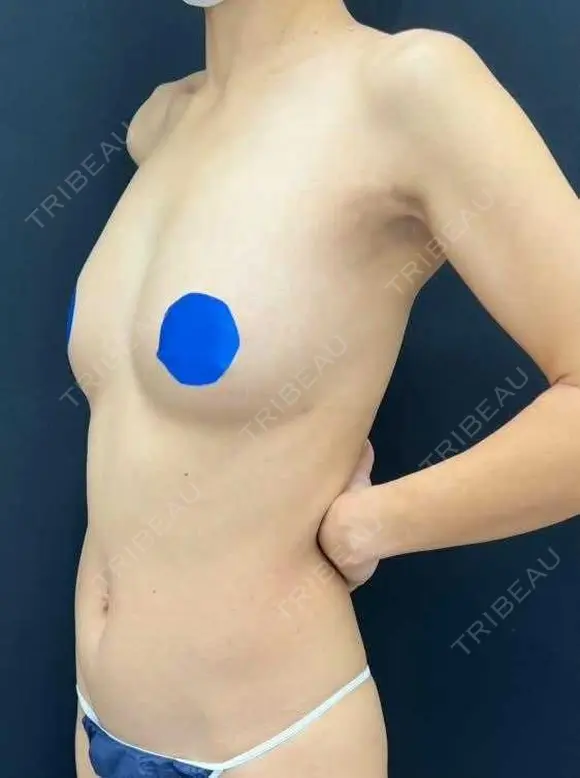 豊胸（脂肪注入） 湘南美容クリニック 吉祥寺院 DAY 92 メイン用