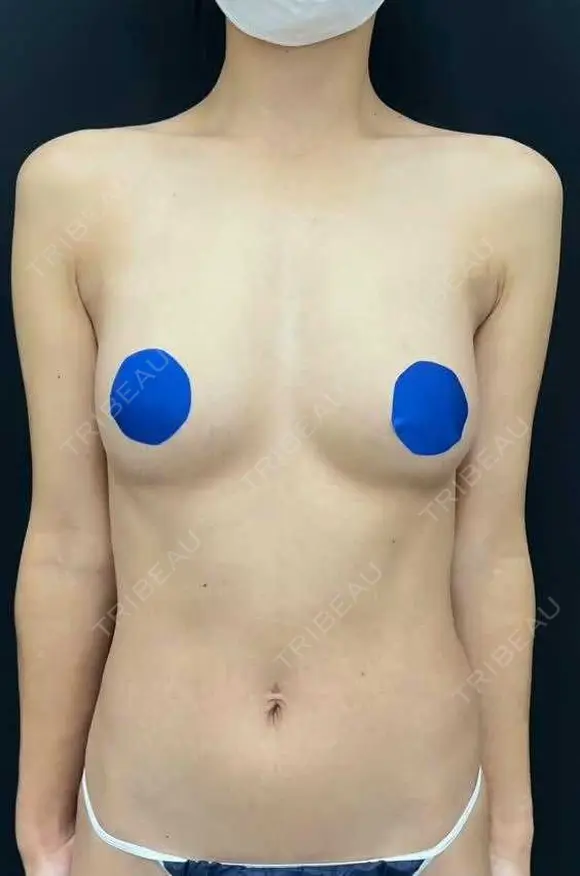 豊胸（脂肪注入） 湘南美容クリニック 吉祥寺院 DAY 92 メイン用