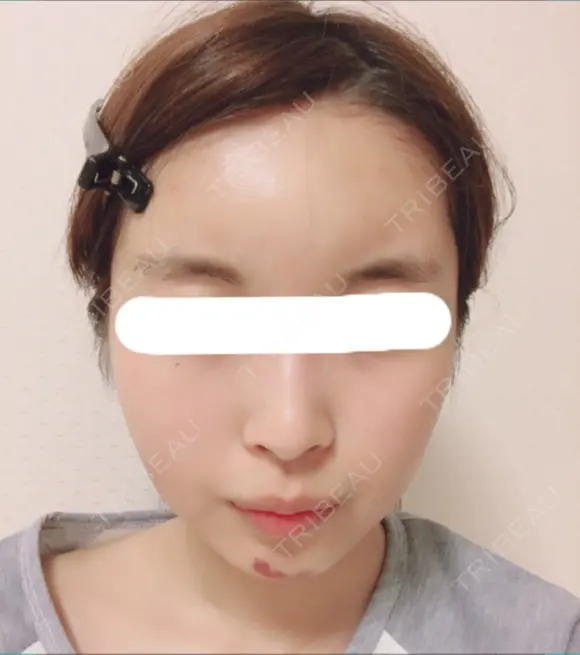 脂肪注入（輪郭） / 再生医療 / PRP皮膚再生療法 チョンダムオラクル皮膚科整形外科医院 DAY 12 メイン用