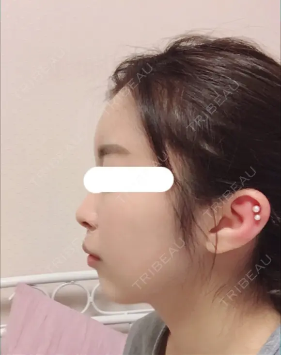 脂肪注入（輪郭） / 再生医療 / PRP皮膚再生療法 チョンダムオラクル皮膚科整形外科医院 AFTER メイン用