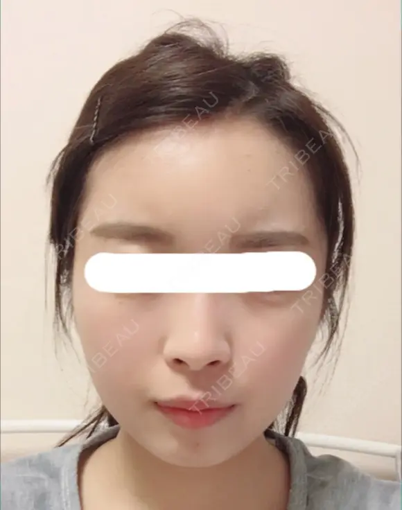 脂肪注入（輪郭） / 再生医療 / PRP皮膚再生療法 チョンダムオラクル皮膚科整形外科医院 DAY 30 メイン用