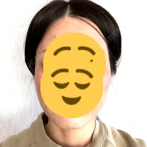 ボトックス（エラ・小顔） TCB東京中央美容外科 梅田茶屋町院 AFTER メイン用