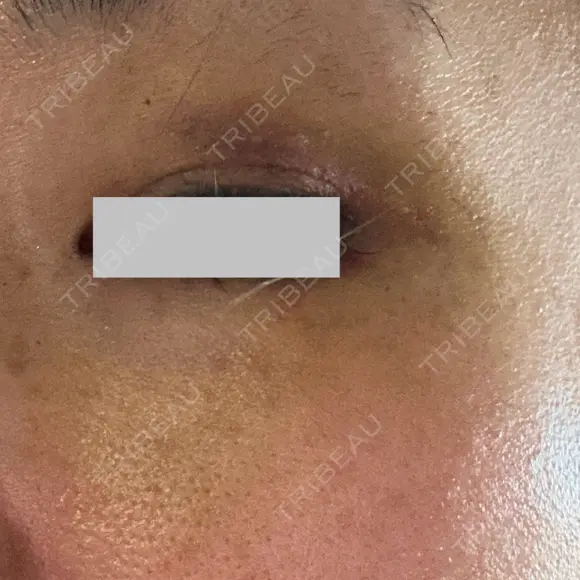 クマ治療 / ボトックス（眉間） / ボトックス（目尻） / ボトックス（額） TCB東京中央美容外科 船橋院 DAY 8 メイン用