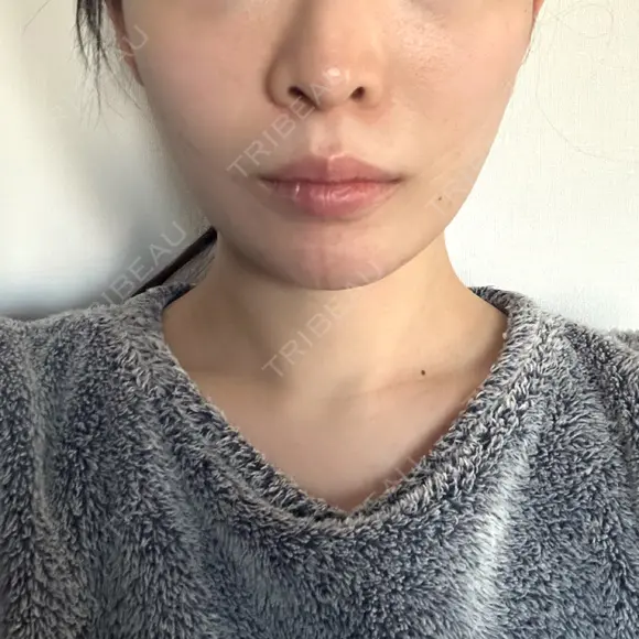 糸リフト / 脂肪吸引（顔） 東京ココセランクリニック DAY 32 メイン用