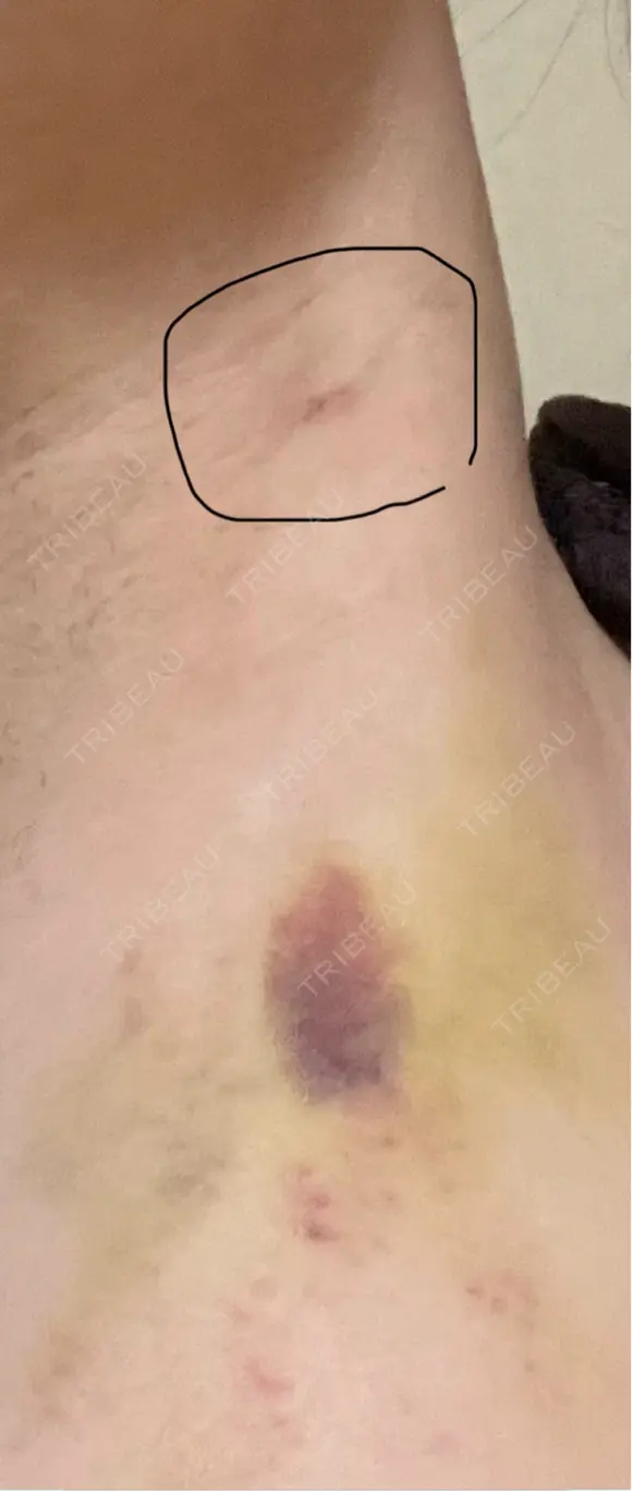 豊胸（脂肪注入） 銀座マイアミ美容外科 DAY 9 メイン用
