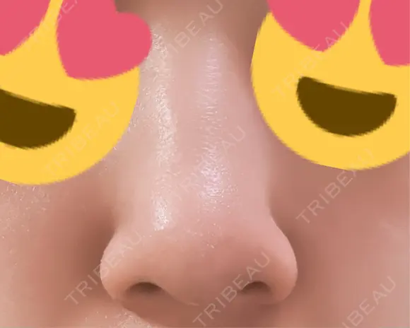 脂肪溶解注射（顔） ファイヤークリニック 銀座院 AFTER メイン用