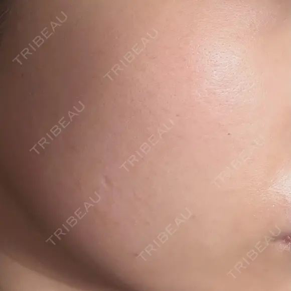 イオン導入 / 毛穴洗浄（ハイドラフェイシャルなど） / 光治療（フォトフェイシャルなど） / その他（鼻） ルラ美容クリニック 札幌本院 AFTER メイン用