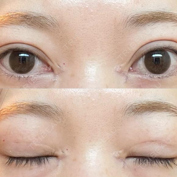 二重埋没 / 目頭切開 アリエル美容クリニック 郡山院 DAY 15 メイン用