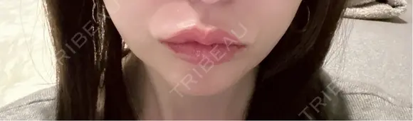 ヒアルロン酸注入（唇） / ピーリング（ニキビ・毛穴） / ルメッカ ルラ美容クリニック 名古屋栄院 / ルラスキンクリニック 名古屋栄院 DAY 1 メイン用