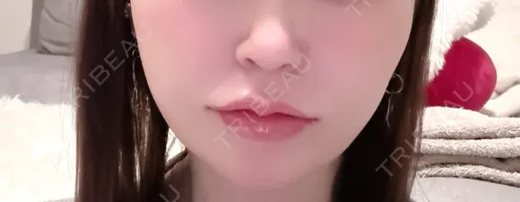 ヒアルロン酸注入（唇） / ピーリング（ニキビ・毛穴） / ルメッカ ルラ美容クリニック 名古屋栄院 / ルラスキンクリニック 名古屋栄院 AFTER メイン用