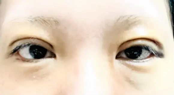二重埋没 / 上まぶたの脂肪取り / ボトックス（額） 9BeautyClinic DAY 2 メイン用