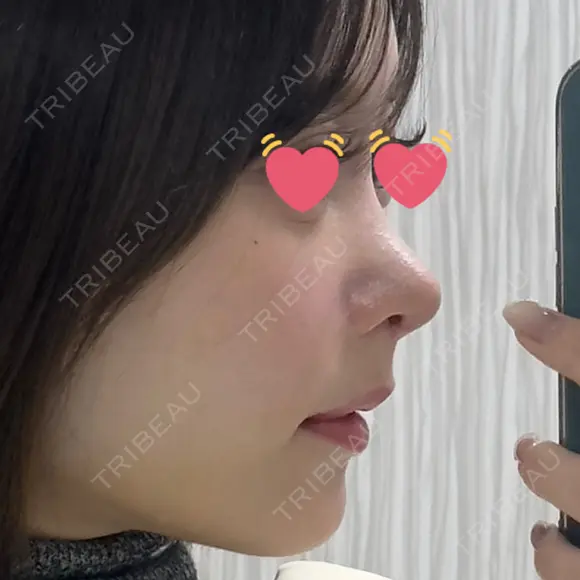 隆鼻術 / 鼻尖形成（切開） / 鼻中隔延長（切開） / 軟骨移植 / 鼻修正 / 鼻尖縮小 / 真皮移植 / 小鼻縮小（非切開） 銀座マイアミ美容外科 DAY 11 メイン用
