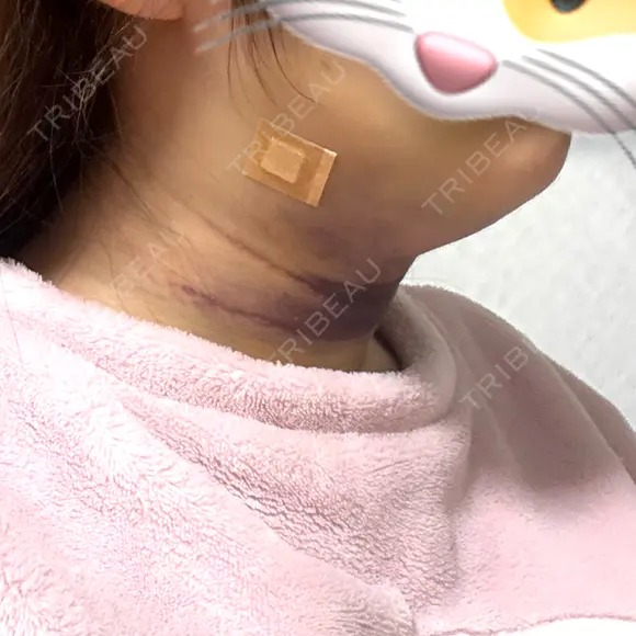 脂肪吸引（顔） TCB東京中央美容外科 新横浜院 DAY 2 メイン用