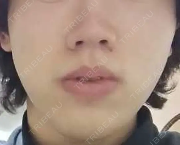 医療脱毛（顔） メンズスキンクリニック 銀座院 DAY 0 メイン用