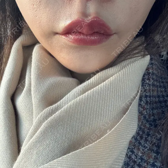 ヒアルロン酸注入（鼻翼基部） ルラ美容クリニック 大宮院 / ルラスキンクリニック 大宮院 DAY 11 メイン用