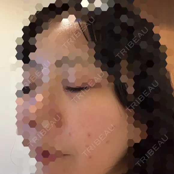 ほくろ・いぼ切除（肌） KARIS beauty clinic DAY 9 メイン用