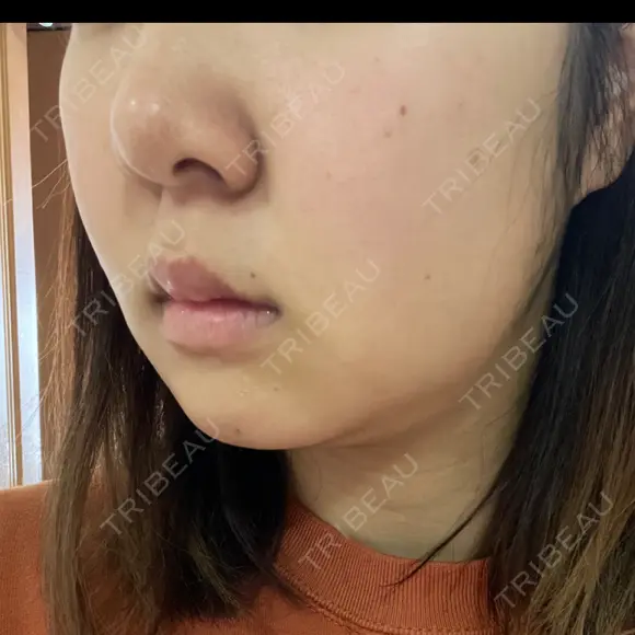 ピーリング（ニキビ・毛穴） / ルメッカ ルラ美容クリニック 横浜院 DAY 7 メイン用