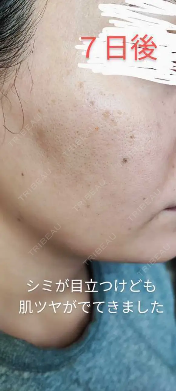 イオン導入 / 毛穴洗浄（ハイドラフェイシャルなど） / ルメッカ ルラ美容クリニック 沖縄院 DAY 20 メイン用