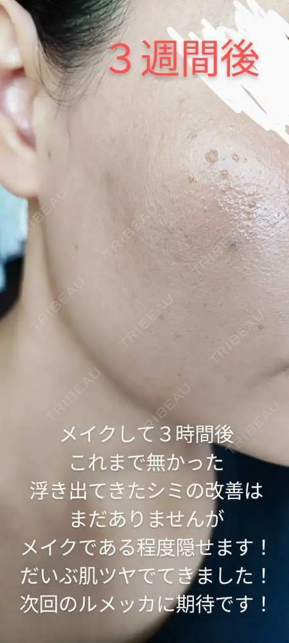 イオン導入 / 毛穴洗浄（ハイドラフェイシャルなど） / ルメッカ ルラ美容クリニック 沖縄院 AFTER メイン用