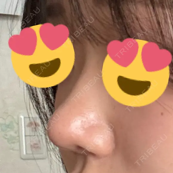 鼻尖形成（切開） / 軟骨移植 / 鼻尖縮小 / 鼻翼基部形成（貴族手術） / ヒアルロン酸注入（鼻翼基部） 東京シンデレラ美容外科 新宿院 DAY 57 メイン用