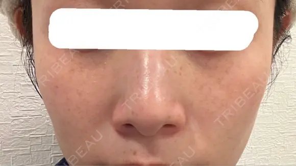 ピコスポット 博多もへじのクリニック AFTER メイン用