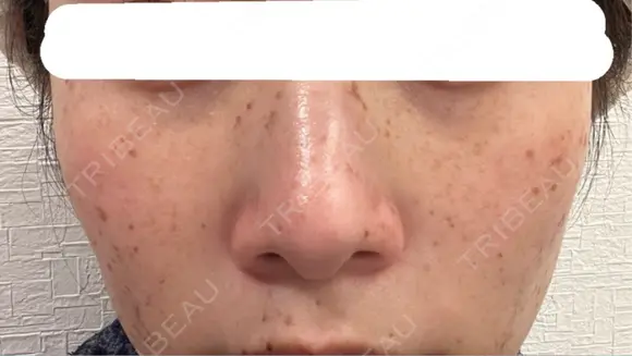 ピコスポット 博多もへじのクリニック DAY 3 メイン用