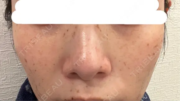 ピコスポット 博多もへじのクリニック DAY 4 メイン用