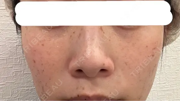 ピコスポット 博多もへじのクリニック DAY 5 メイン用