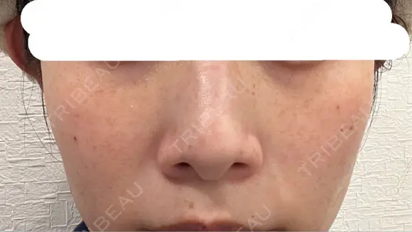 ピコスポット 博多もへじのクリニック DAY 8 メイン用