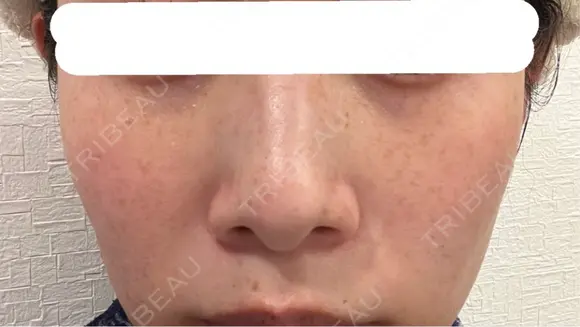 ピコスポット 博多もへじのクリニック DAY 9 メイン用