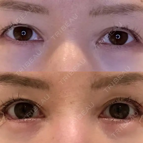 目尻切開 / タレ目形成・グラマラスライン（埋没） LOUIS CLINIC 二子玉川院【ルイクリニック】 DAY 4 メイン用