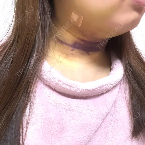 脂肪吸引（顔） TCB東京中央美容外科 新横浜院 DAY 4 メイン用