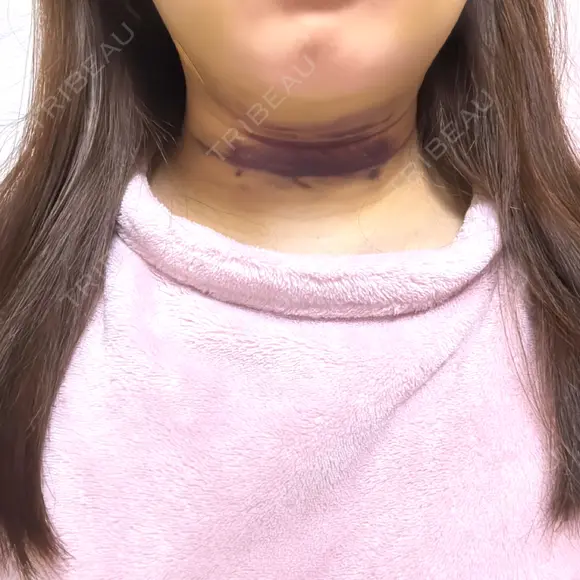 脂肪吸引（顔） TCB東京中央美容外科 新横浜院 DAY 4 メイン用