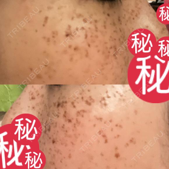 ルメッカ MIO CLINIC 梅田院 DAY 3 メイン用