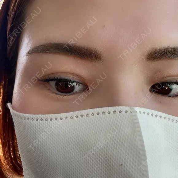 目頭切開 / その他（目元） Leap beauty clinic AFTER メイン用