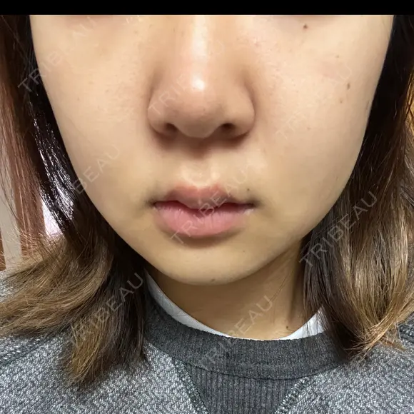 ピーリング（ニキビ・毛穴） / ルメッカ ルラ美容クリニック 横浜院 DAY 9 メイン用