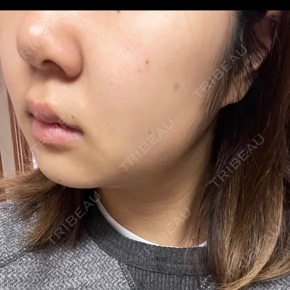 ピーリング（ニキビ・毛穴） / ルメッカ ルラ美容クリニック 横浜院 DAY 9 メイン用