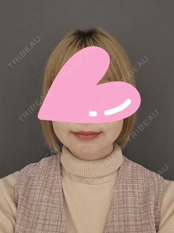 糸リフト / 脂肪吸引（顔） / メーラーファット除去 / ジョールファット除去 / 脂肪吸引注射（顔） ziz CLINIC AFTER メイン用