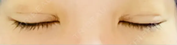 二重埋没 / 上まぶたの脂肪取り / ボトックス（額） 9BeautyClinic DAY 5 メイン用
