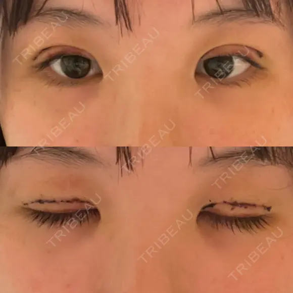 二重切開 / 眼瞼下垂（切開） / 上まぶたたるみ取り ユア美容クリニック 福岡院 DAY 3 メイン用