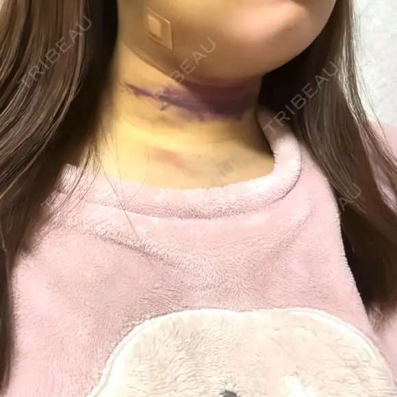 脂肪吸引（顔） TCB東京中央美容外科 新横浜院 DAY 5 メイン用