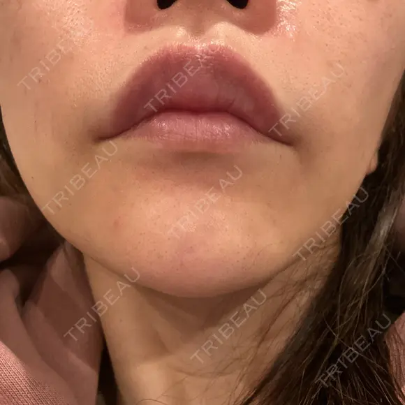 ヒアルロン酸注入（鼻翼基部） ルラ美容クリニック 大宮院 / ルラスキンクリニック 大宮院 DAY 12 メイン用