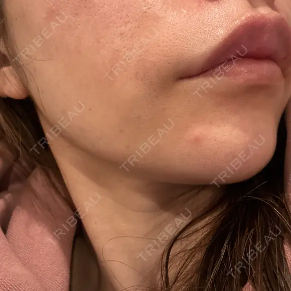 ヒアルロン酸注入（鼻翼基部） ルラ美容クリニック 大宮院 / ルラスキンクリニック 大宮院 DAY 12 メイン用