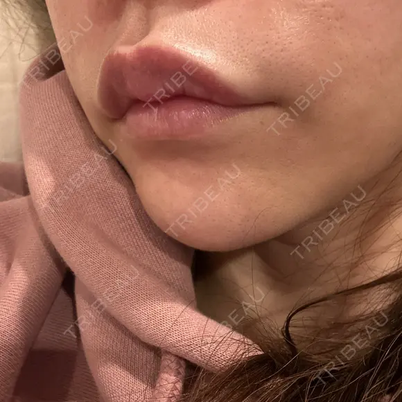 ヒアルロン酸注入（鼻翼基部） ルラ美容クリニック 大宮院 / ルラスキンクリニック 大宮院 DAY 12 メイン用