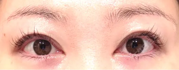 目頭切開 / 目尻切開 EMMA CLINIC（エマクリニック） AFTER メイン用