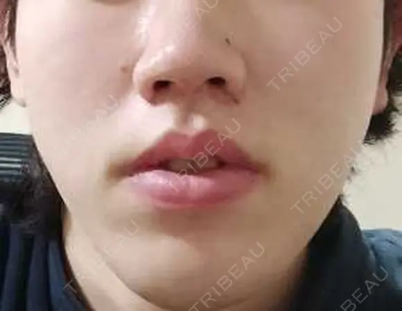 医療脱毛（顔） メンズスキンクリニック 銀座院 AFTER メイン用