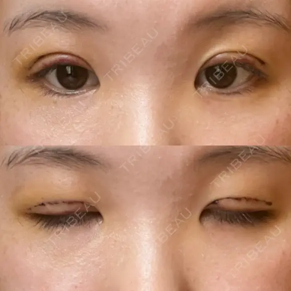 二重切開 / 眼瞼下垂（切開） / 上まぶたたるみ取り ユア美容クリニック 福岡院 DAY 4 メイン用
