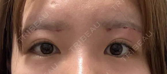 眉下切開 Barbie Clinic DAY 39 メイン用
